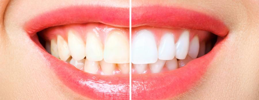 Whiten Your Teeth