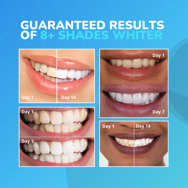 LumiSmile Advanced Teeth Whitening Strips: 8+ Shades Whiter in Just 14 Days (Sold Out) - 2