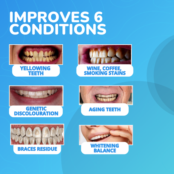 LumiSmile Advanced Teeth Whitening Strips: 8+ Shades Whiter in Just 14 Days (Sold Out) - 5